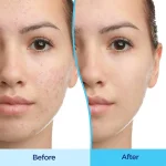 ژل دیفرین حجم 30 میلی لیتر - تصویر 5